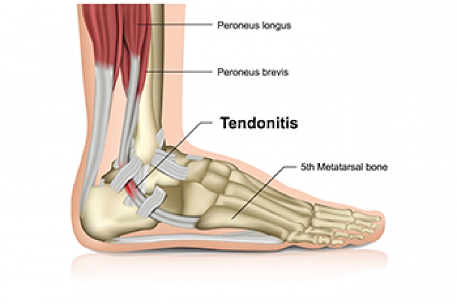 definition-and-causes-of-achilles-tendon-injuries